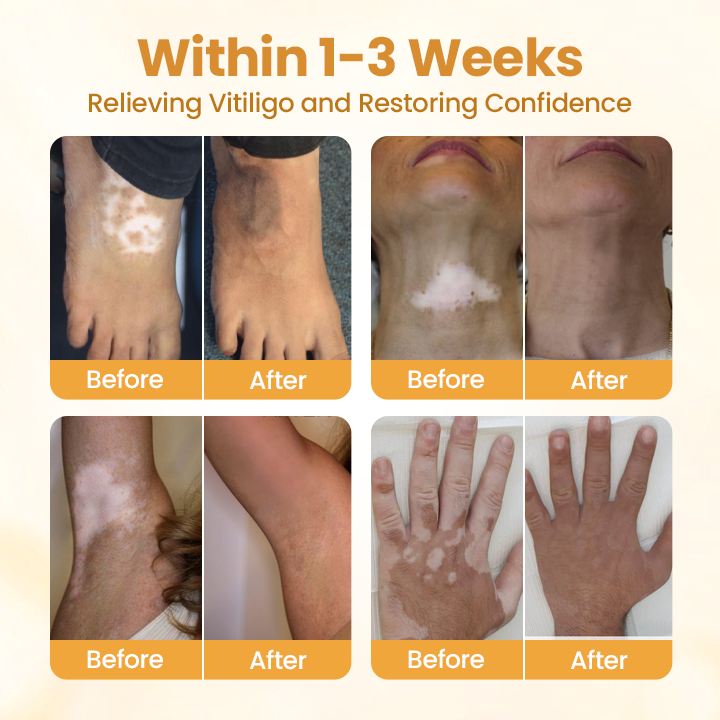 VitiClear Pro Bee Venom Cream