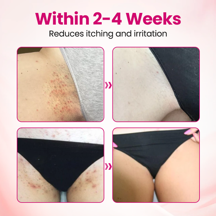 EvaHeal® IntiDefend Anti-HPV Interferon Gel✅