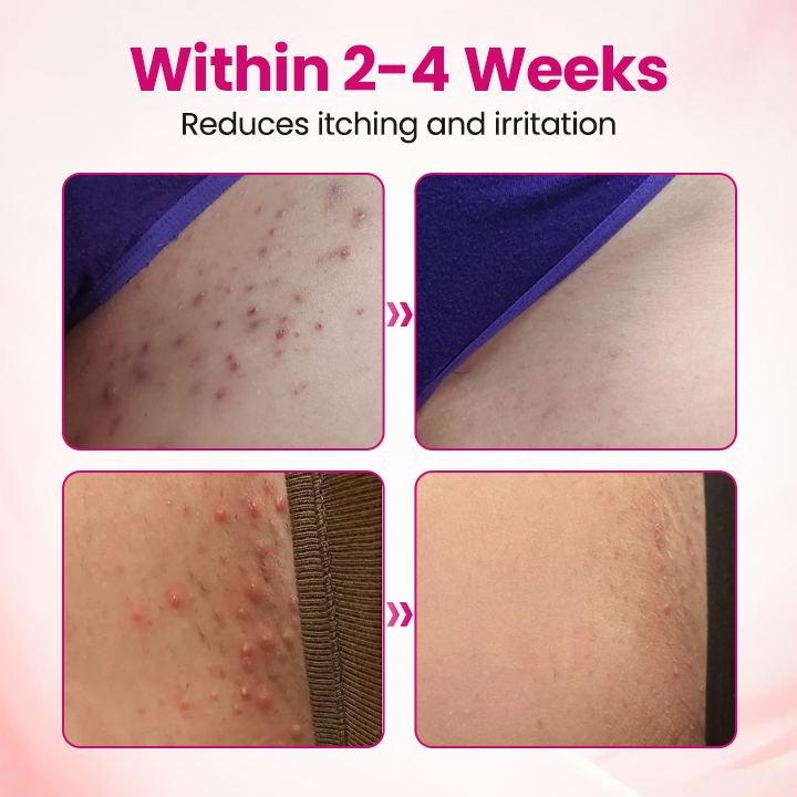 EvaHeal® IntiDefend Anti-HPV Interferon Gel✅