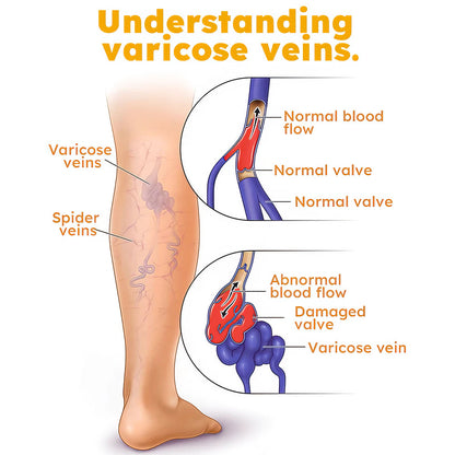 Bees Venom Varicose Veins Cream