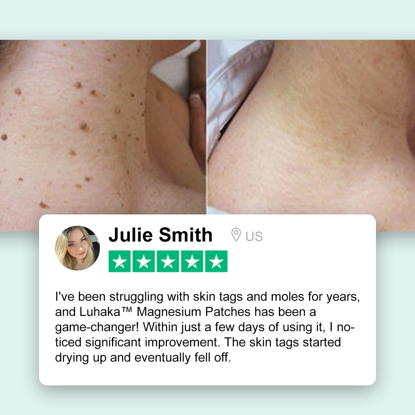 Magnesium Micro-pin Wart Removal Patch