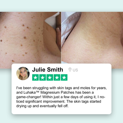 Magnesium Micro-pin Wart Removal Patch