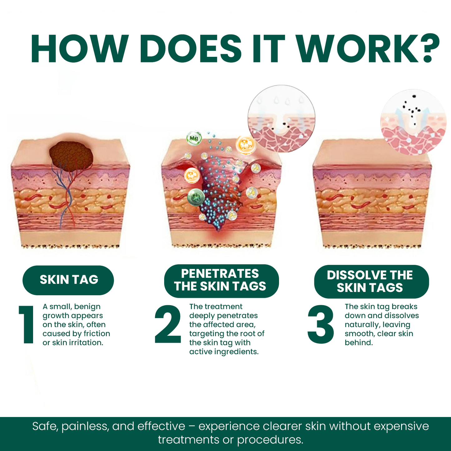 Magnesium Micro-pin Wart Removal Patch