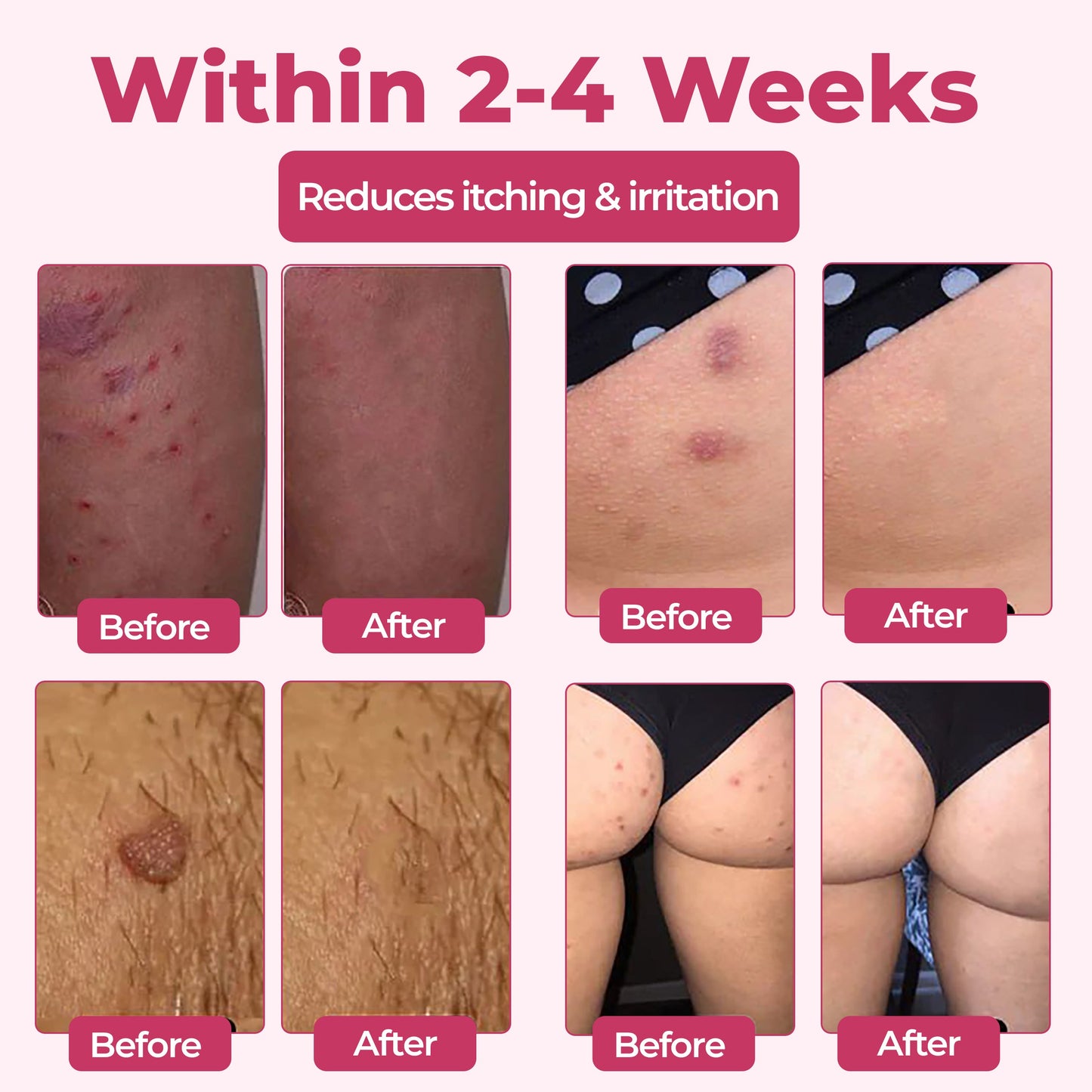 ♀️ Woman's Genital HPV Relief Cream 🔥HOT SALE UP TO 60% OFF