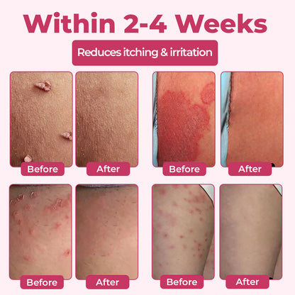 ♀️ Woman's Genital HPV Relief Cream 🔥HOT SALE UP TO 60% OFF